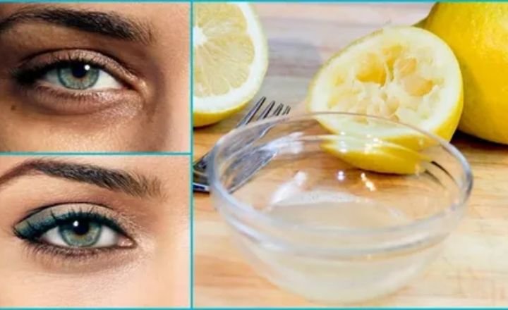 How to Remove Dark Spots With Lemon Juice